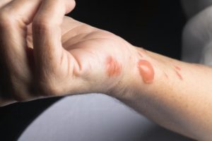 Treatment for a Burn