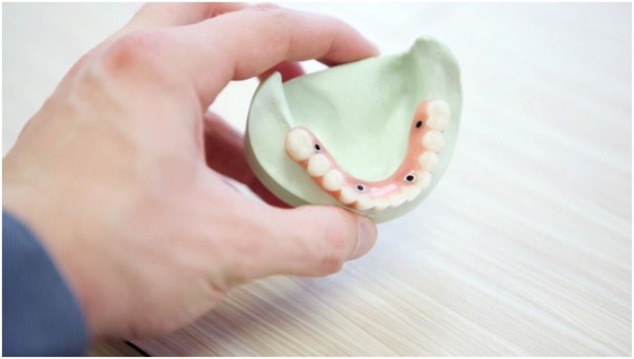 Dental Implant Procedure