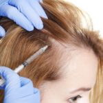 Female Hair Loss Treatment