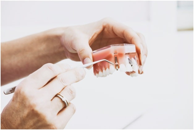 dental implants