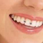 6 Tips to Heal Tooth Decay and Recover Cavities