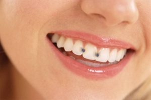 6 Tips to Heal Tooth Decay and Recover Cavities
