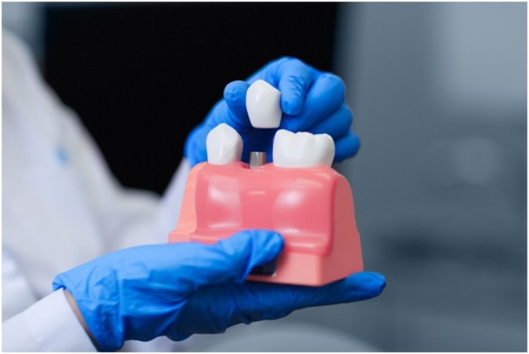 Is it worth having oral implants fitted? 5 overlooked health benefits of dental implants