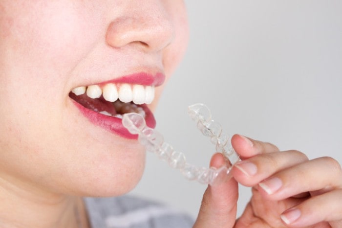 Invisalign