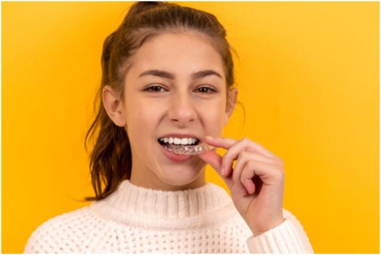 Clear aligners; what are they and how to get them!