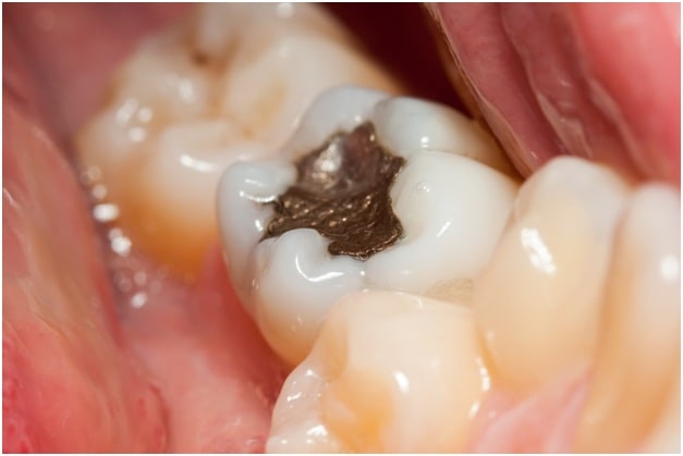 teeth overlapping